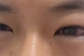 Bỏng giác mạc do gội đầu bằng nước hạt na: Lời cảnh tỉnh cho cha mẹ