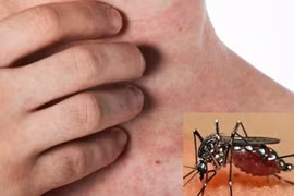 Phân biệt sốt xuất huyết và sốt thông thường, dấu hiệu nào cần lưu ý?