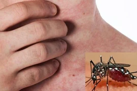 Phân biệt sốt xuất huyết và sốt thông thường, dấu hiệu nào cần lưu ý?