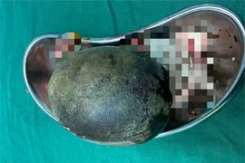 Lấy viên sỏi "khủng" nặng đến 700g, trong bàng quang người đàn ông 45 tuổi