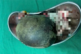 Lấy viên sỏi "khủng" nặng đến 700g, trong bàng quang người đàn ông 45 tuổi