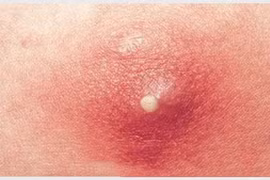 Bé trai 11 tuổi viêm phổi hoại tử nặng vì nhiễm khuẩn từ nốt nhọt