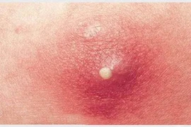 Bé trai 11 tuổi viêm phổi hoại tử nặng vì nhiễm khuẩn từ nốt nhọt