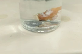 Đau ngực, khó thở, đi khám bất ngờ phát hiện răng giả mắc kẹt trong phổi