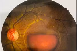 Cảnh báo chấn thương mắt do tia laser