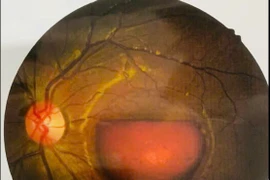 Cảnh báo chấn thương mắt do tia laser