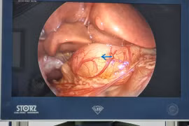 Đi khám vì vàng da sơ sinh, không ngờ phát hiện hẹp phì đại môn vị