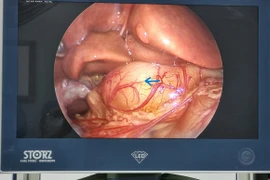 Đi khám vì vàng da sơ sinh, không ngờ phát hiện hẹp phì đại môn vị