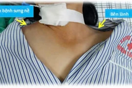 Hệ lụy của việc tự tiêm thuốc ở nhà