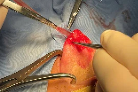 Bóc tách thành công khối u lưỡi cho bệnh nhân 36 tuổi