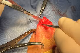 Bóc tách thành công khối u lưỡi cho bệnh nhân 36 tuổi