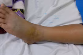 Cảnh báo gia tăng trẻ nhập viện do rắn cắn trong mùa mưa