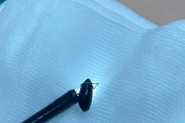 Cứu bé 20 tháng tuổi tím tái vì hóc hạt na