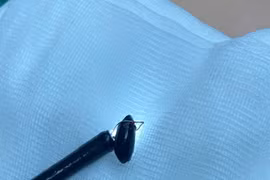 Cứu bé 20 tháng tuổi tím tái vì hóc hạt na