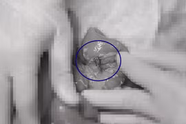 Bệnh nhi thủng ruột, sốc nhiễm khuẩn do.... nuốt phải hạt táo đỏ