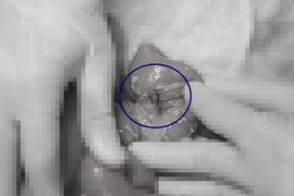 Bệnh nhi thủng ruột, sốc nhiễm khuẩn do.... nuốt phải hạt táo đỏ