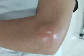 Nguy hại từ việc tiêm khớp không an toàn