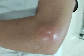 Nguy hại từ việc tiêm khớp không an toàn