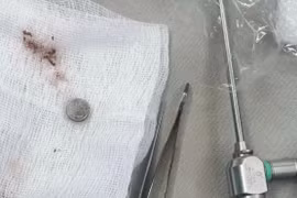 Gắp dị vật trong mũi bé trai hơn 3 tuổi: Lời cảnh tỉnh cho cha mẹ