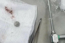 Gắp dị vật trong mũi bé trai hơn 3 tuổi: Lời cảnh tỉnh cho cha mẹ