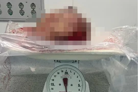 Phẫu thuật cắt bỏ khối u vú "khủng" cho nữ bệnh nhân 44 tuổi