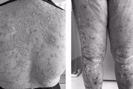 Bệnh vảy nến: Sự kỳ thị là nỗi ám ảnh