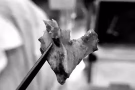 Mảnh xương "ngủ quên" trong... mũi suốt 10 tháng