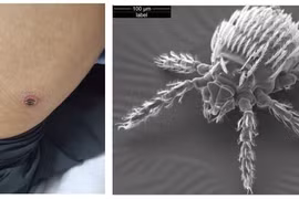 Người đàn ông 48 tuổi bị suy hô hấp do ve mò cắn