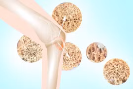 Người bị bệnh loãng xương nên kiêng gì?