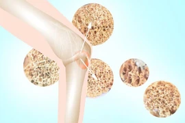 Người bị bệnh loãng xương nên kiêng gì?