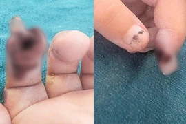 Bé gái 3 tuổi bị đứt rời búp ngón tay do kẹp vào cửa siêu thị