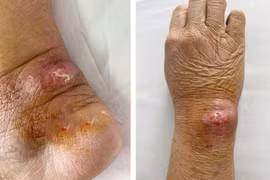 Nhiều người nhập viện vì mèo cào, sơ cứu vết thương thế nào?