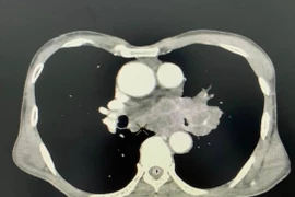 Mệt mỏi, sút cân, đi khám bất ngờ phát hiện u phổi ác tính