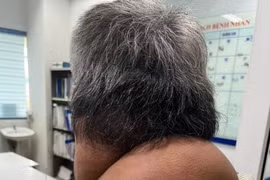 Mắc bệnh "người gấu" vì... nghiện rượu lâu năm