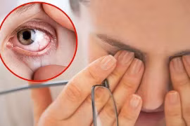 "Điểm" 4 bệnh mắt thường gặp vào mùa mưa, cần lưu ý
