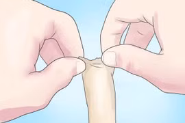 Chủ quan lộn bao quy đầu tại nhà, bé trai 5 tuổi nhập viện 