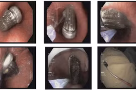 Nữ sinh vô tình nuốt... bàn chải dài 15cm vào bụng