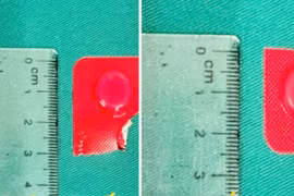 Viên thuốc còn nguyên vỏ cắm sâu trong thực quản người phụ nữ 54 tuổi