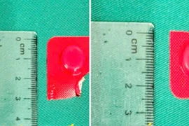 Viên thuốc còn nguyên vỏ cắm sâu trong thực quản người phụ nữ 54 tuổi