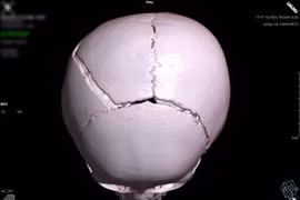 Bé gái 15 tháng tuổi bị cổng sắt đổ sập vào đầu gây chấn thương nặng