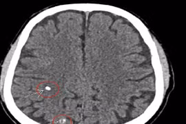 Đi khám bệnh tuyến giáp, người đàn ông 66 tuổi bất ngờ phát hiện sán não