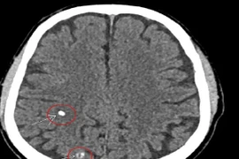Đi khám bệnh tuyến giáp, người đàn ông 66 tuổi bất ngờ phát hiện sán não