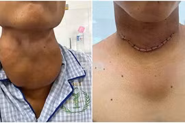 Thanh niên bị khối bướu giáp nặng 600gr chèn ép đường thở, không thể cúi đầu