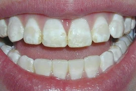 Top thực phẩm có thể "bào mòn" men răng không phải ai cũng biết