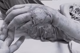 Chủ quan với nốt phồng nhỏ, người phụ nữ suýt mất bàn tay