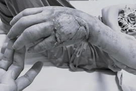 Chủ quan với nốt phồng nhỏ, người phụ nữ suýt mất bàn tay