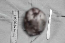 Ngực to bất thường, cô gái đi khám phát hiện khối u "khủng"