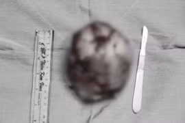 Ngực to bất thường, cô gái đi khám phát hiện khối u "khủng"