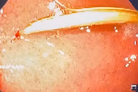 Thủng tá tràng vì... thói quen ngậm tăm sau ăn