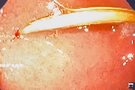 Thủng tá tràng vì... thói quen ngậm tăm sau ăn